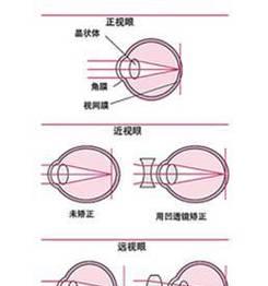 激光智能弱视眼镜效果如何？适合哪些人群？