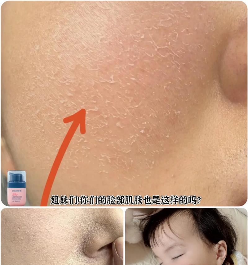 换季时脸上脱皮怎么办（针对不同肤质的换季护肤方法和常见误区）