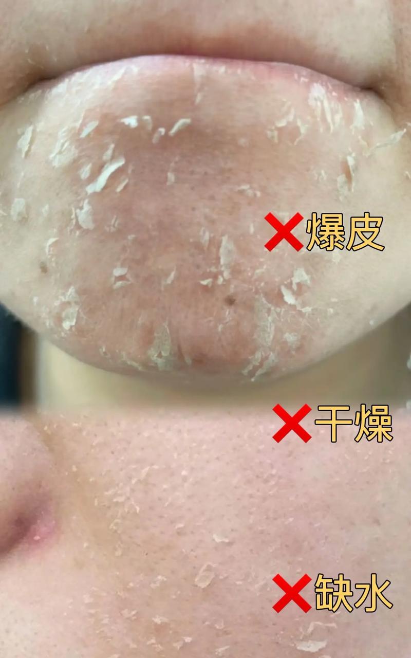 换季时脸上脱皮怎么办（针对不同肤质的换季护肤方法和常见误区）